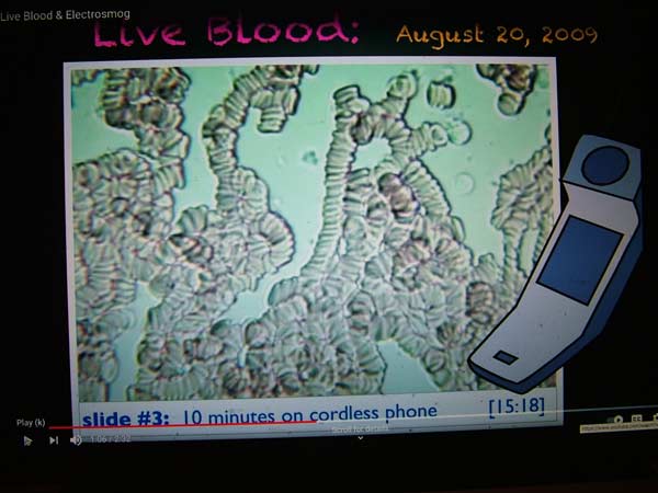 Red blood cells clumping and rouleaux after 10 min. on cordless phone